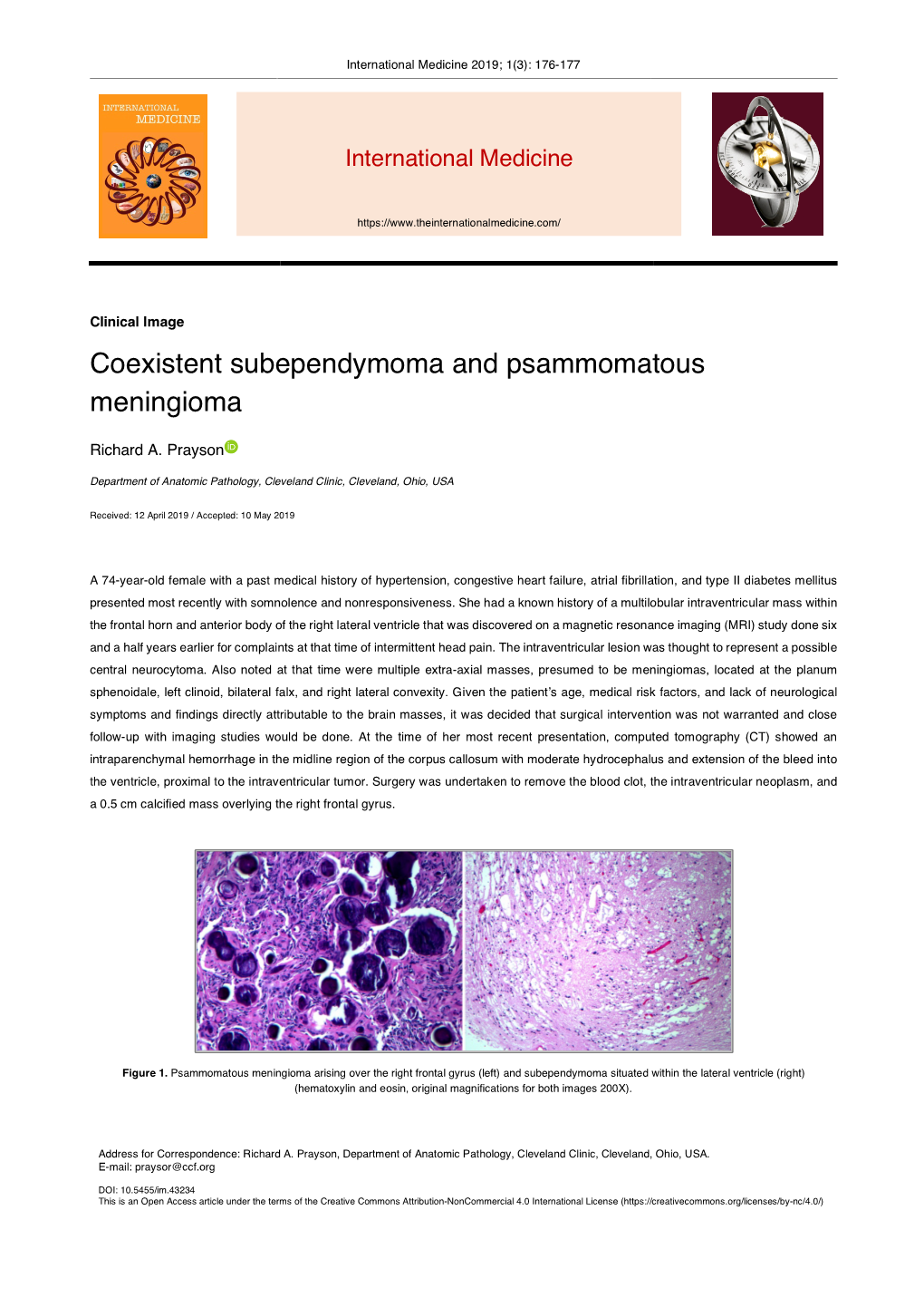 Coexistent Subependymoma and Psammomatous Meningioma