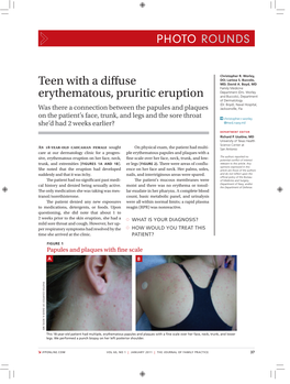 Teen with a Diffuse Erythematous, Pruritic Eruption
