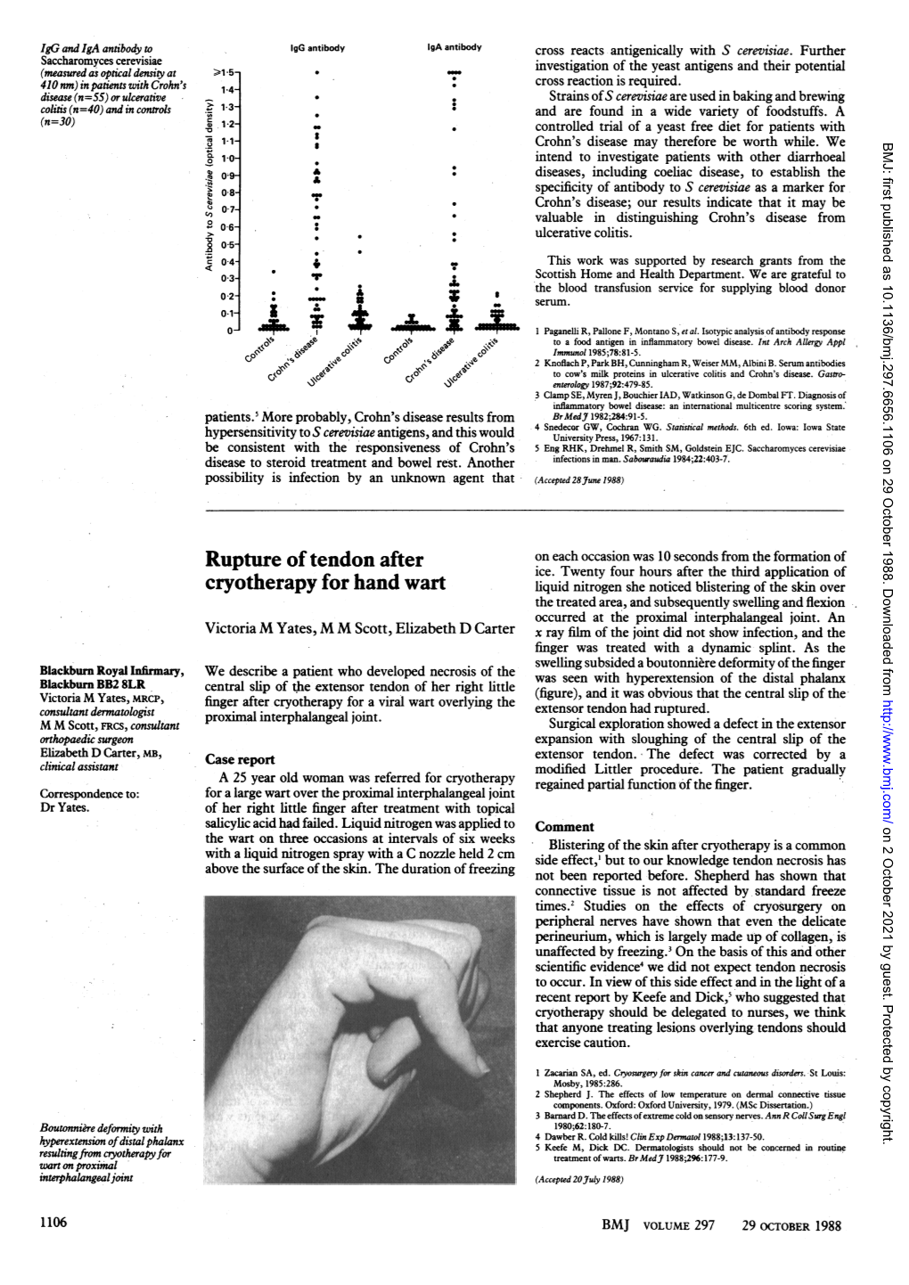 Rupture of Tendon After Cryotherapy for Hand Wart