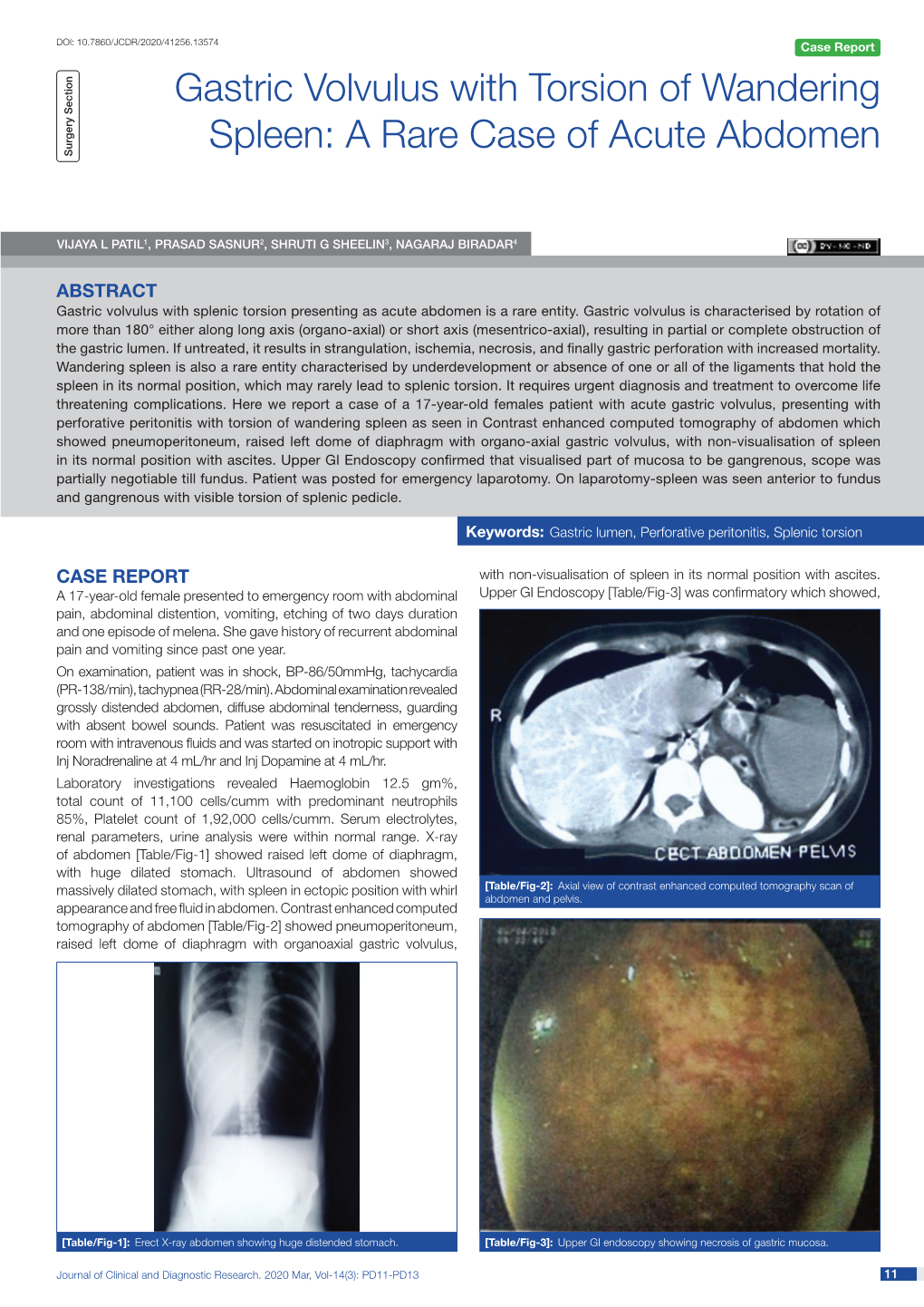 Gastric Volvulus with Torsion of Wandering Spleen: a Rare Case of Acute Abdomen Surgery Section