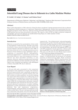 Interstitial Lung Disease Due to Siderosis in a Lathe Machine Worker