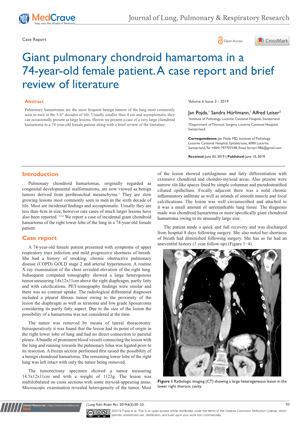 Giant Pulmonary Chondroid Hamartoma in a 74-Year-Old Female Patient