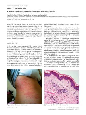 Urticarial Vasculitis Associated with Essential Thrombocythaemia