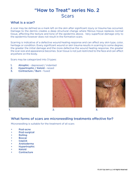 “How to Treat” Series No. 2 Scars What Is a Scar?