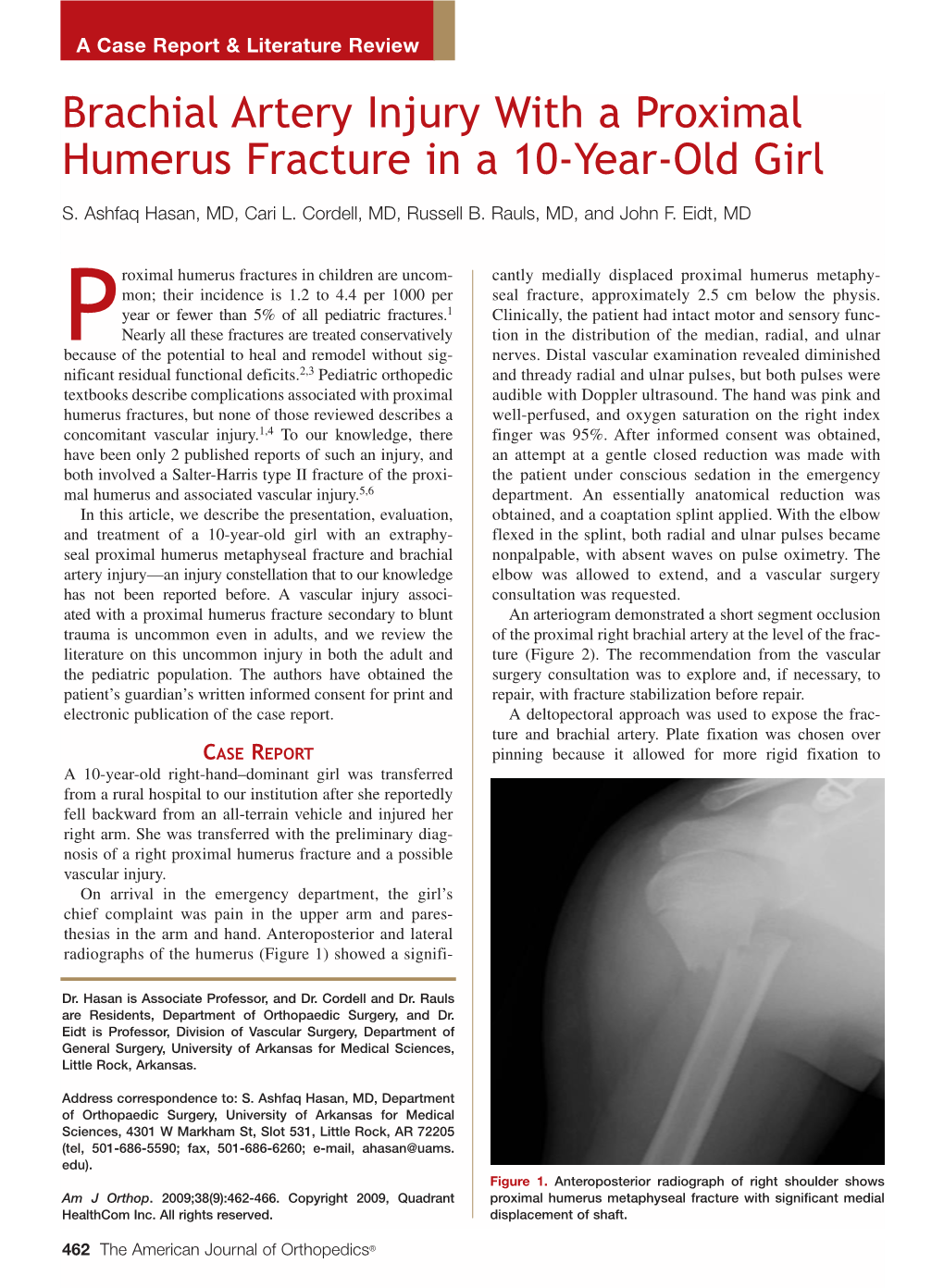 Brachial Artery Injury with a Proximal Humerus Fracture in a 10-Year-Old Girl