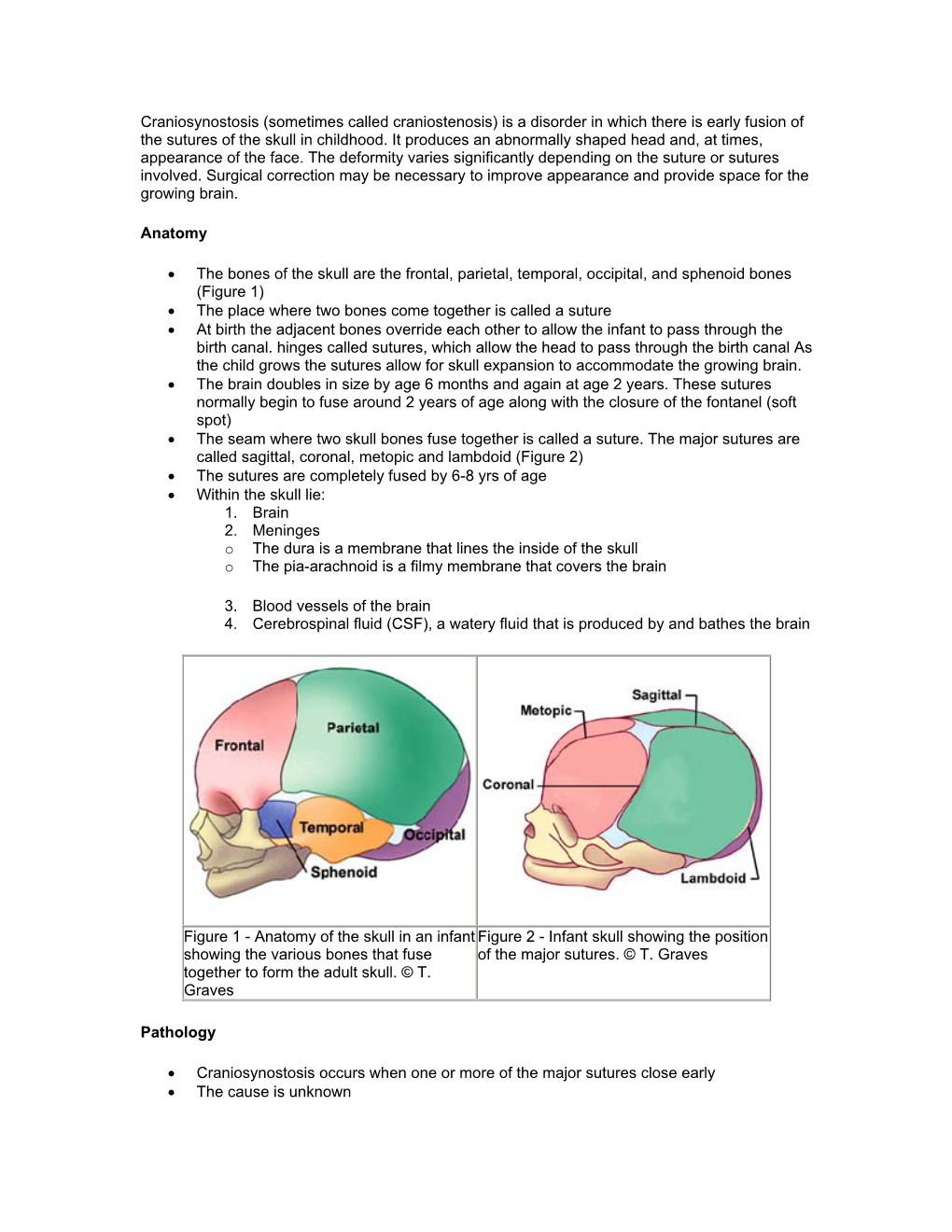 Craniosynostosis (Sometimes Called Craniostenosis) Is a Disorder in Which There Is Early Fusion of the Sutures of the Skull in Childhood