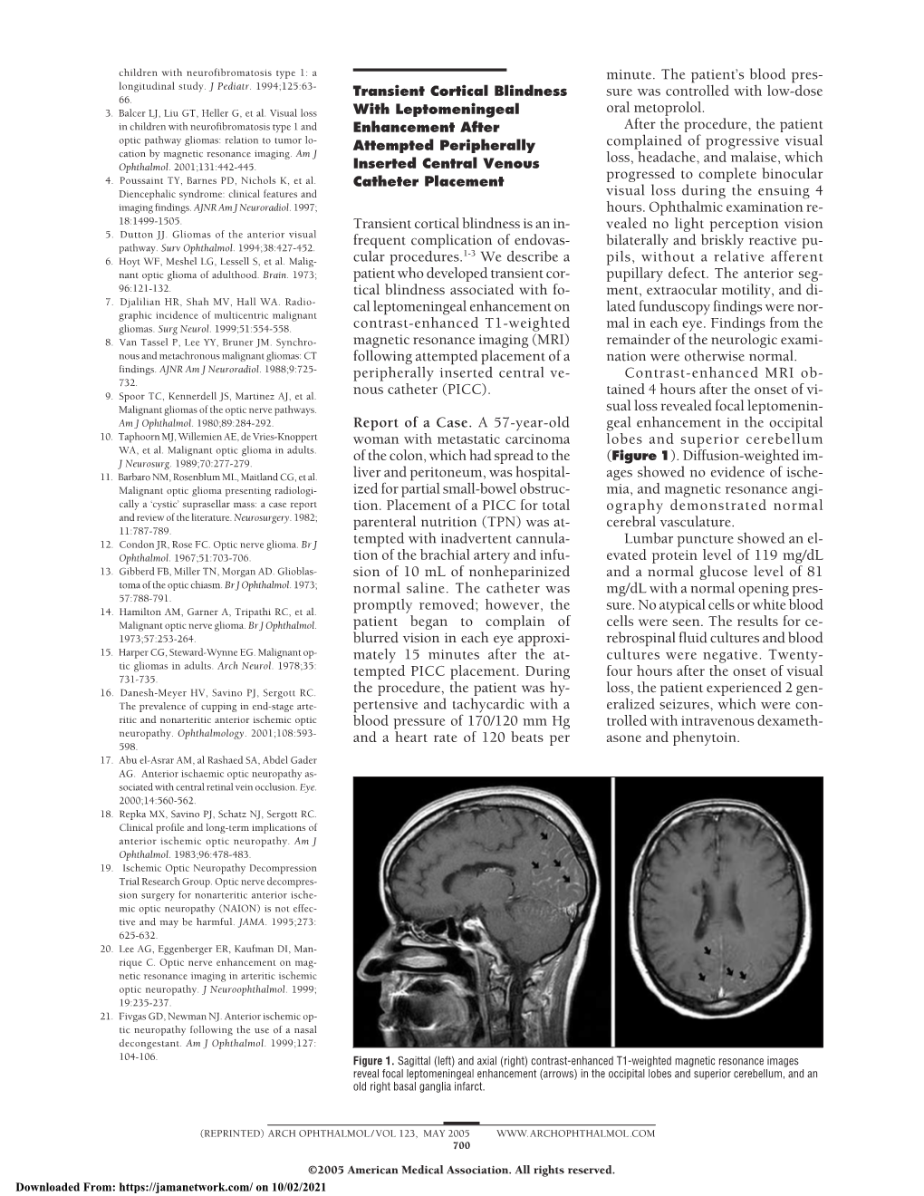 Transient Cortical Blindness with Leptomeningeal Enhancement