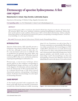 Dermoscopy of Apocrine Hydrocystoma: a First Case Report Balachandra S