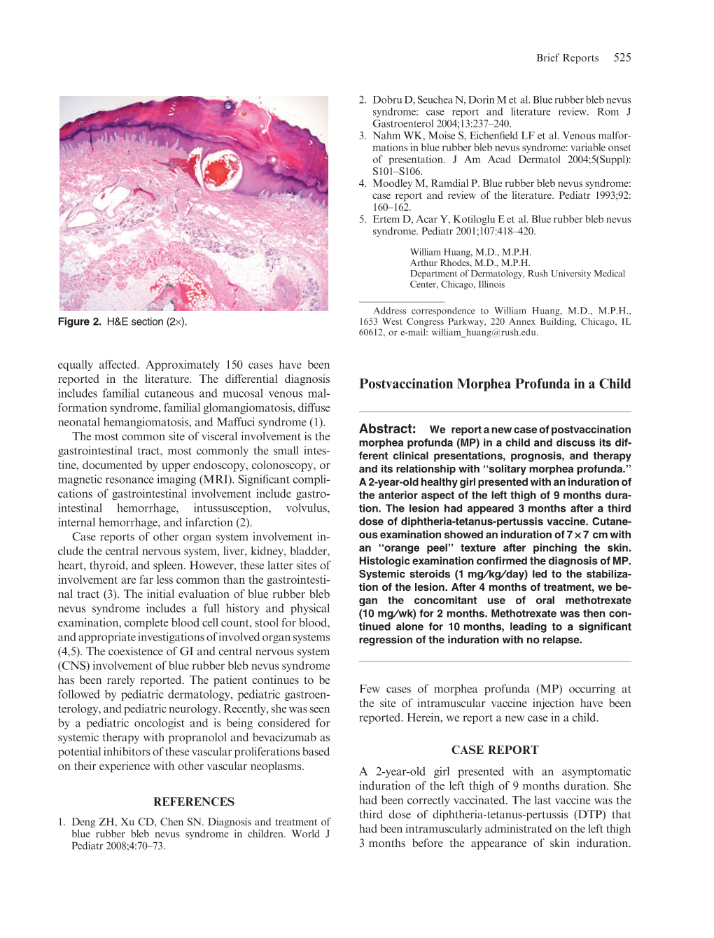 Postvaccination Morphea Profunda in a Child