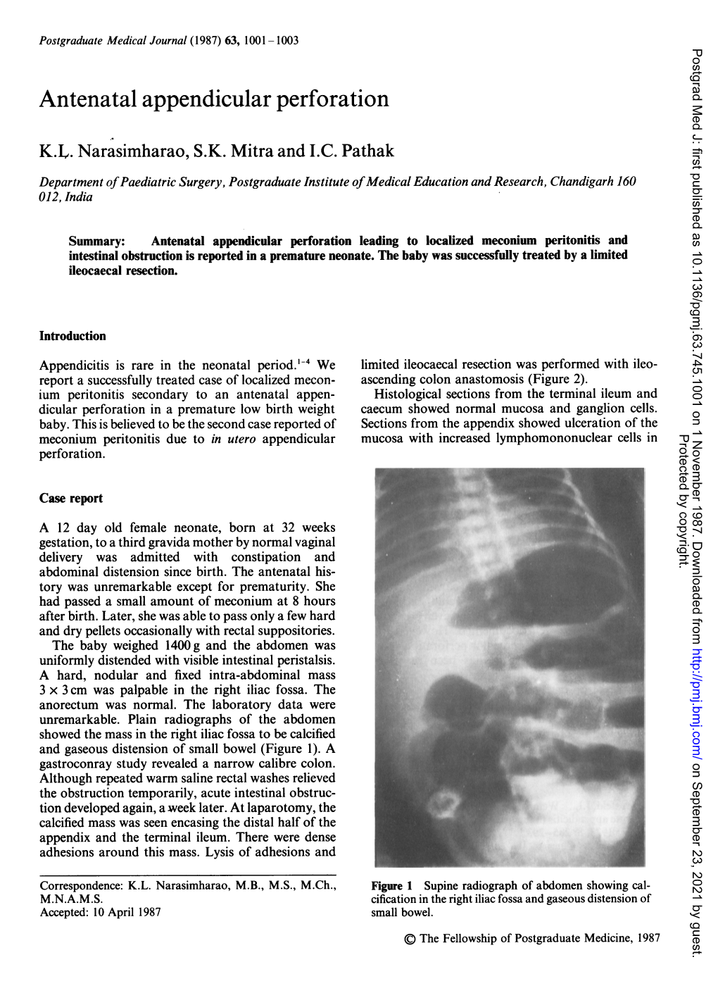 Antenatal Appendicular Perforation K.L