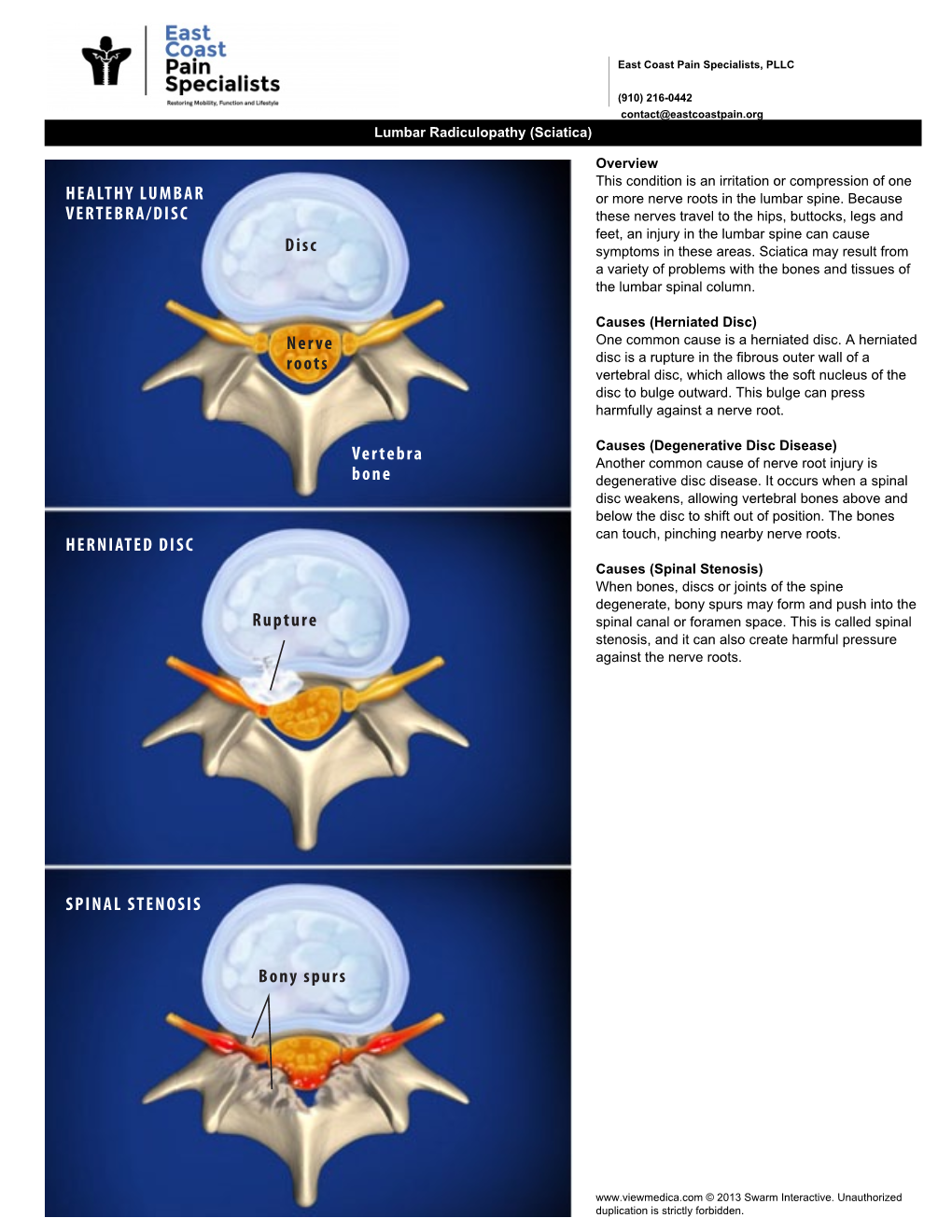 Lumbar Radiculopathy (Sciatica)