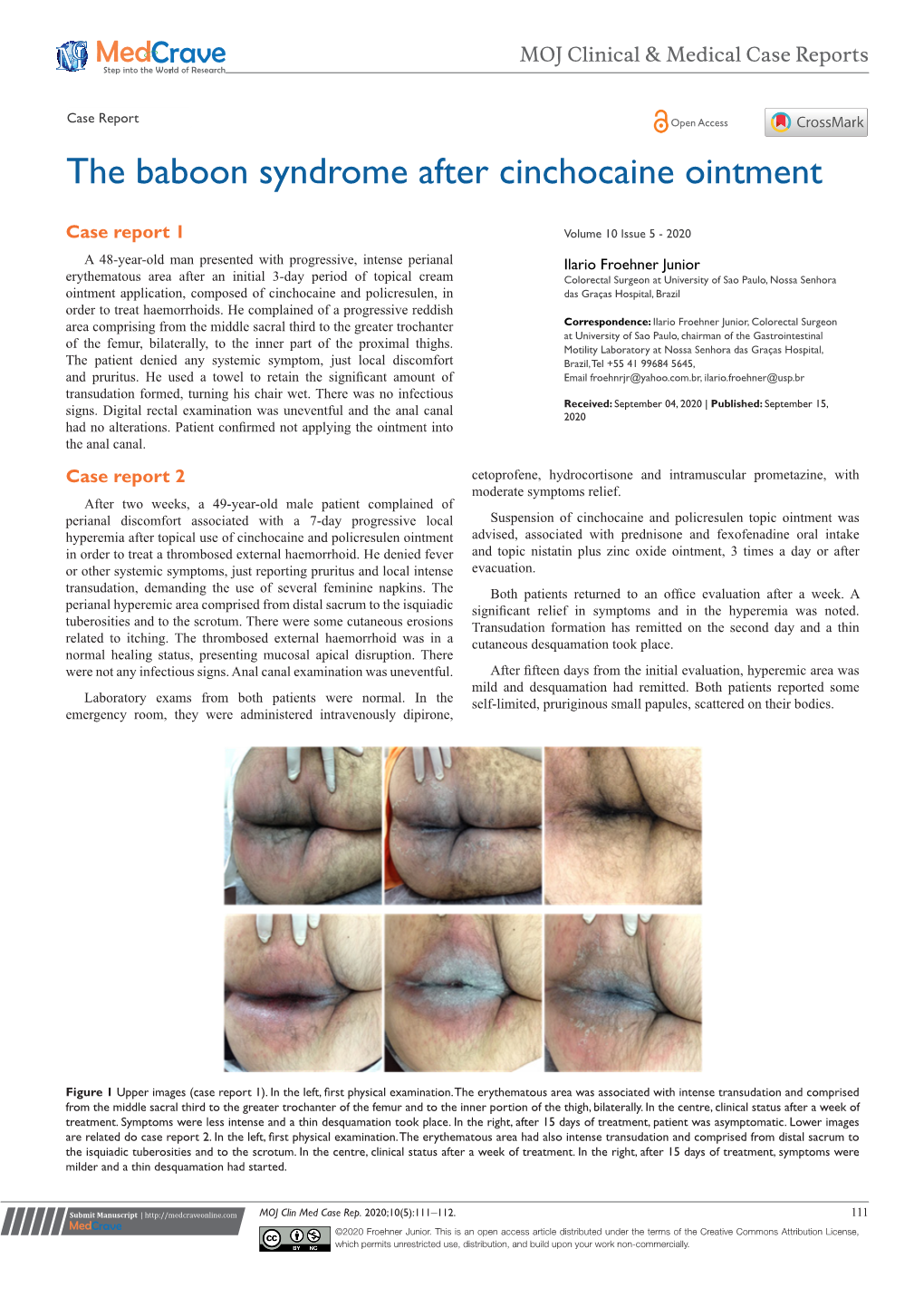 The Baboon Syndrome After Cinchocaine Ointment