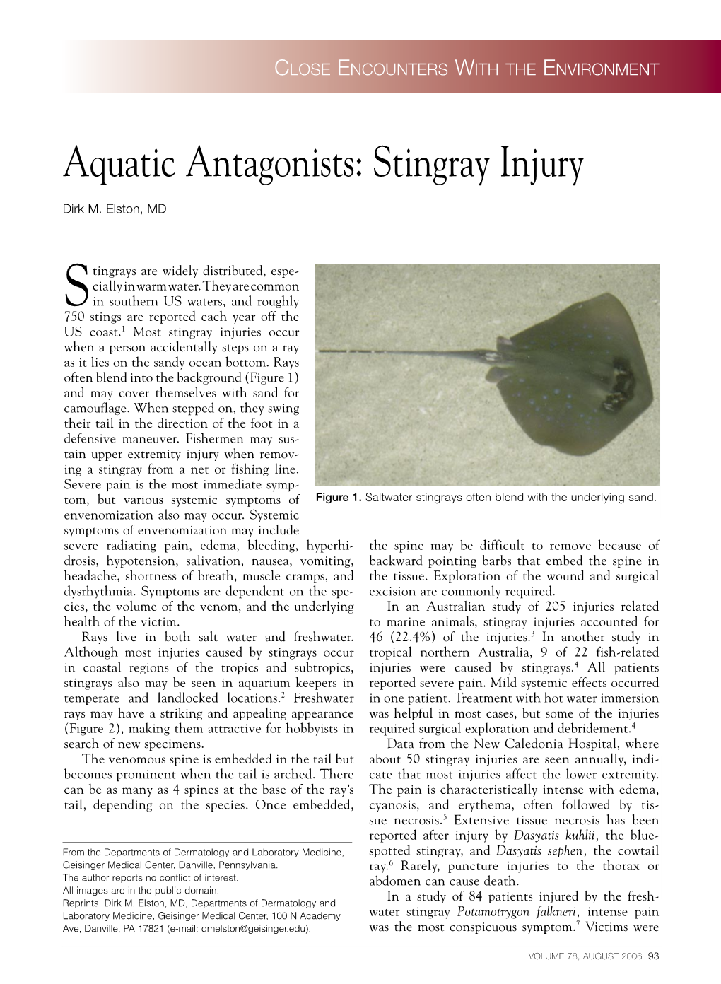 Stingray Injury