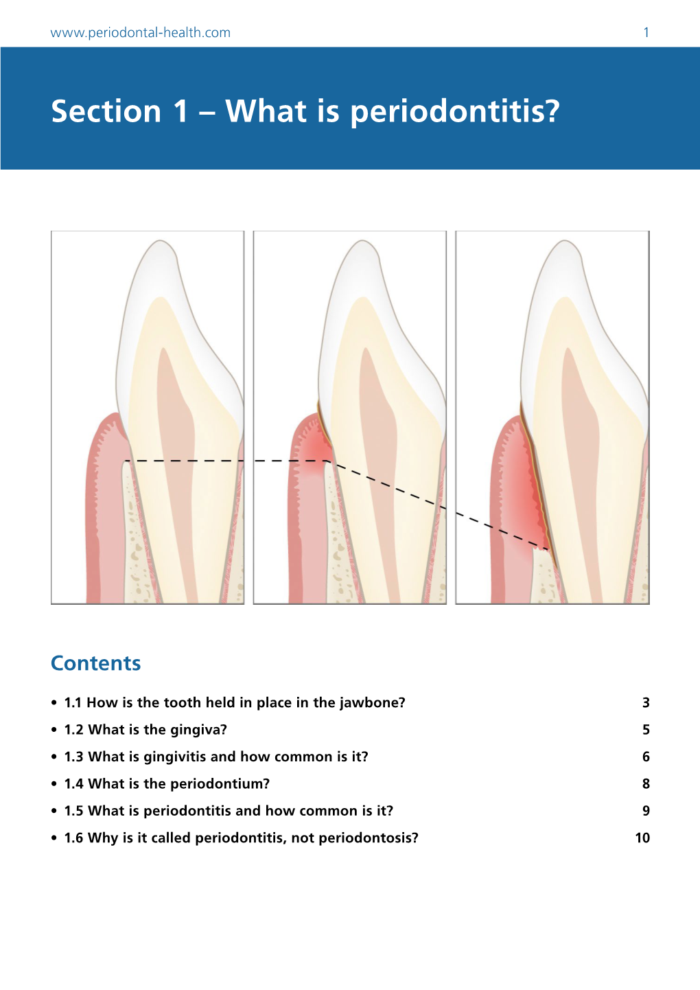 Section 1 – What Is Periodontitis?