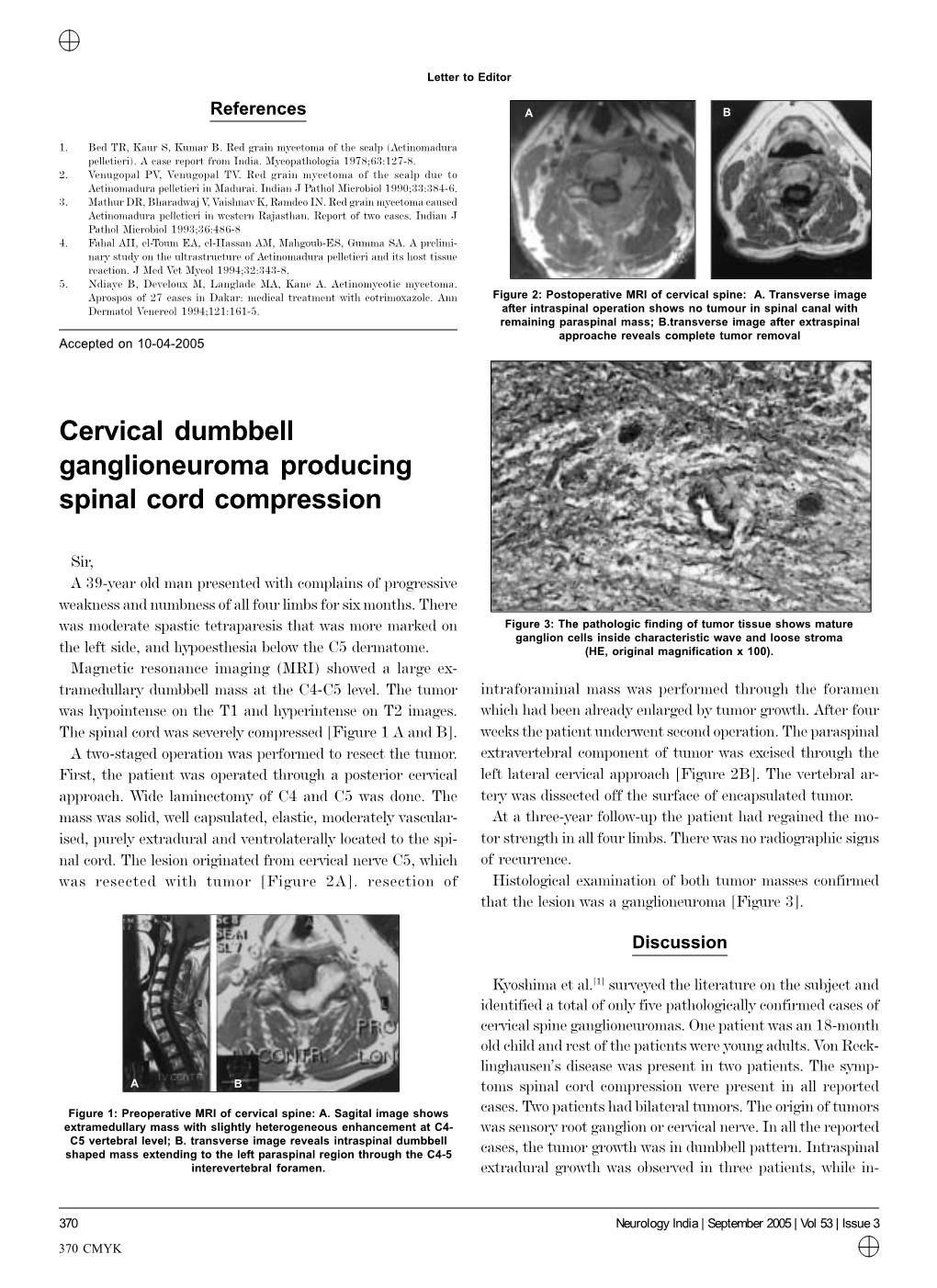 Cervical Dumbbell Ganglioneuroma Producing Spinal Cord Compression