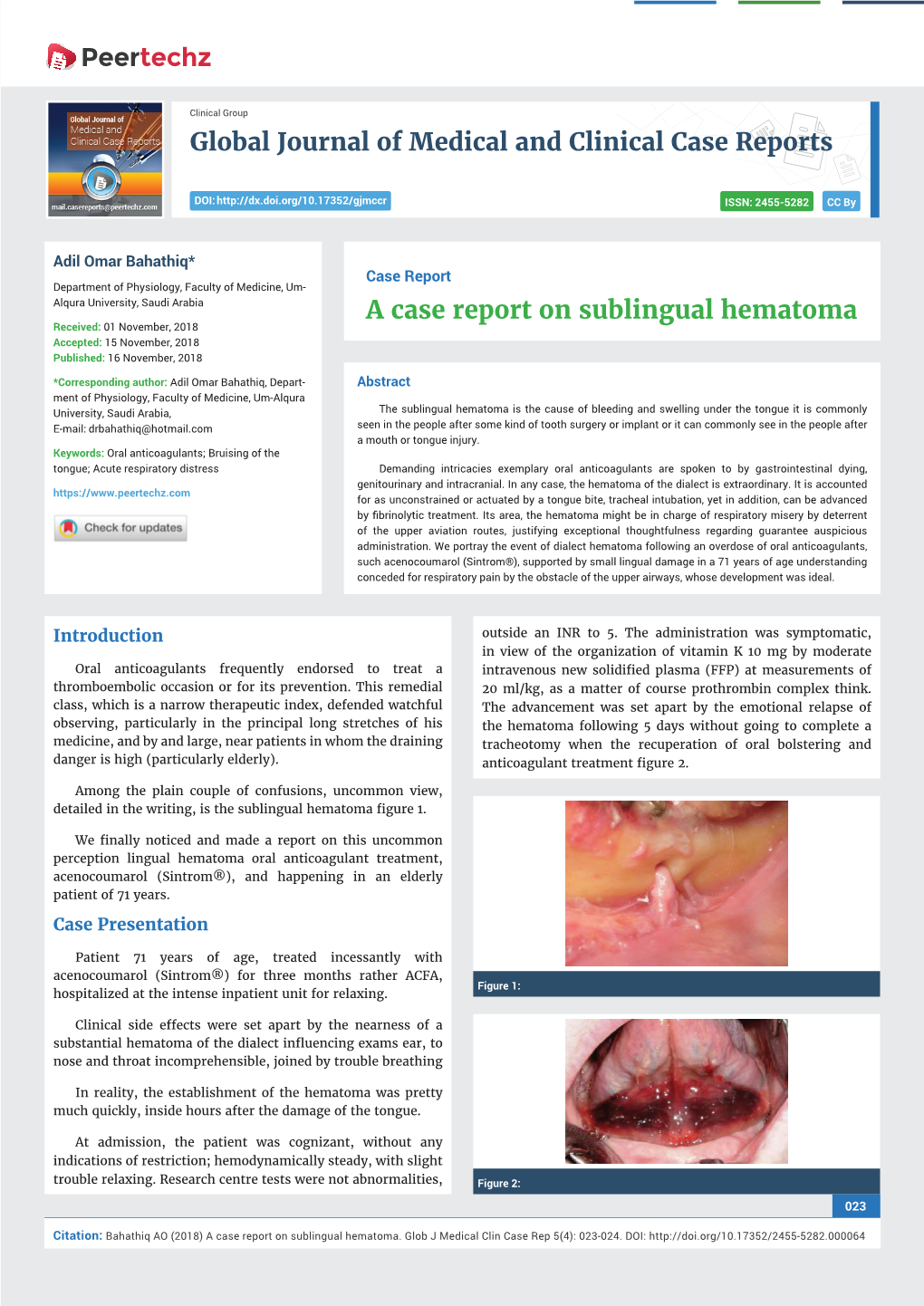 A Case Report on Sublingual Hematoma Received: 01 November, 2018 Accepted: 15 November, 2018 Published: 16 November, 2018