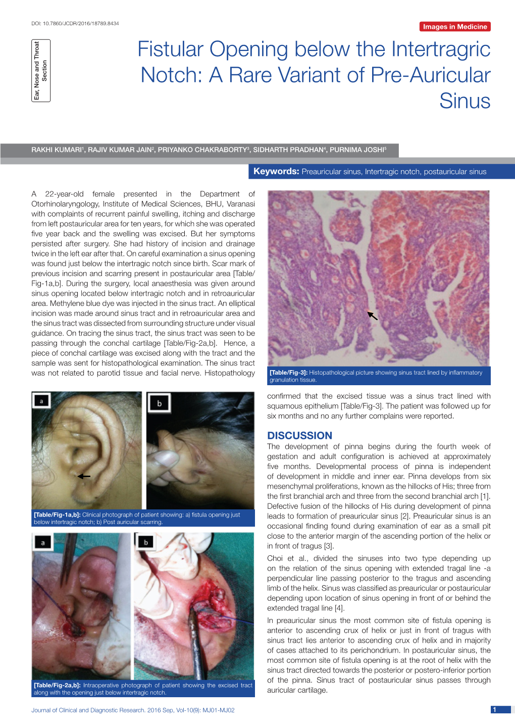 A Rare Variant of Pre-Auricular Sinus