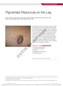Pigmented Peduncule on the Leg