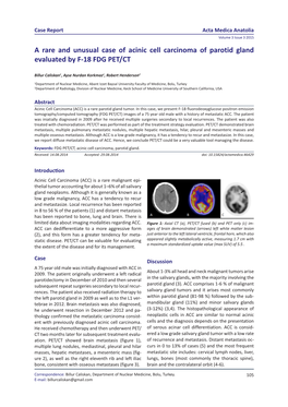 A Rare and Unusual Case of Acinic Cell Carcinoma of Parotid Gland Evaluated by F-18 FDG PET/CT