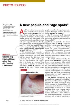 A New Papule and “Age Spots”