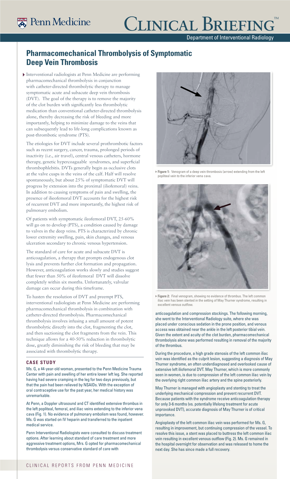 Pharmacomechanical Thrombolysis of Symptomatic Deep Vein Thrombosis