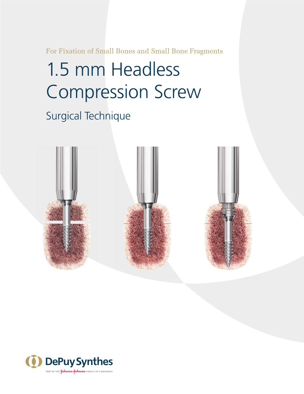 1.5 Mm Headless Compression Screw Surgical Technique