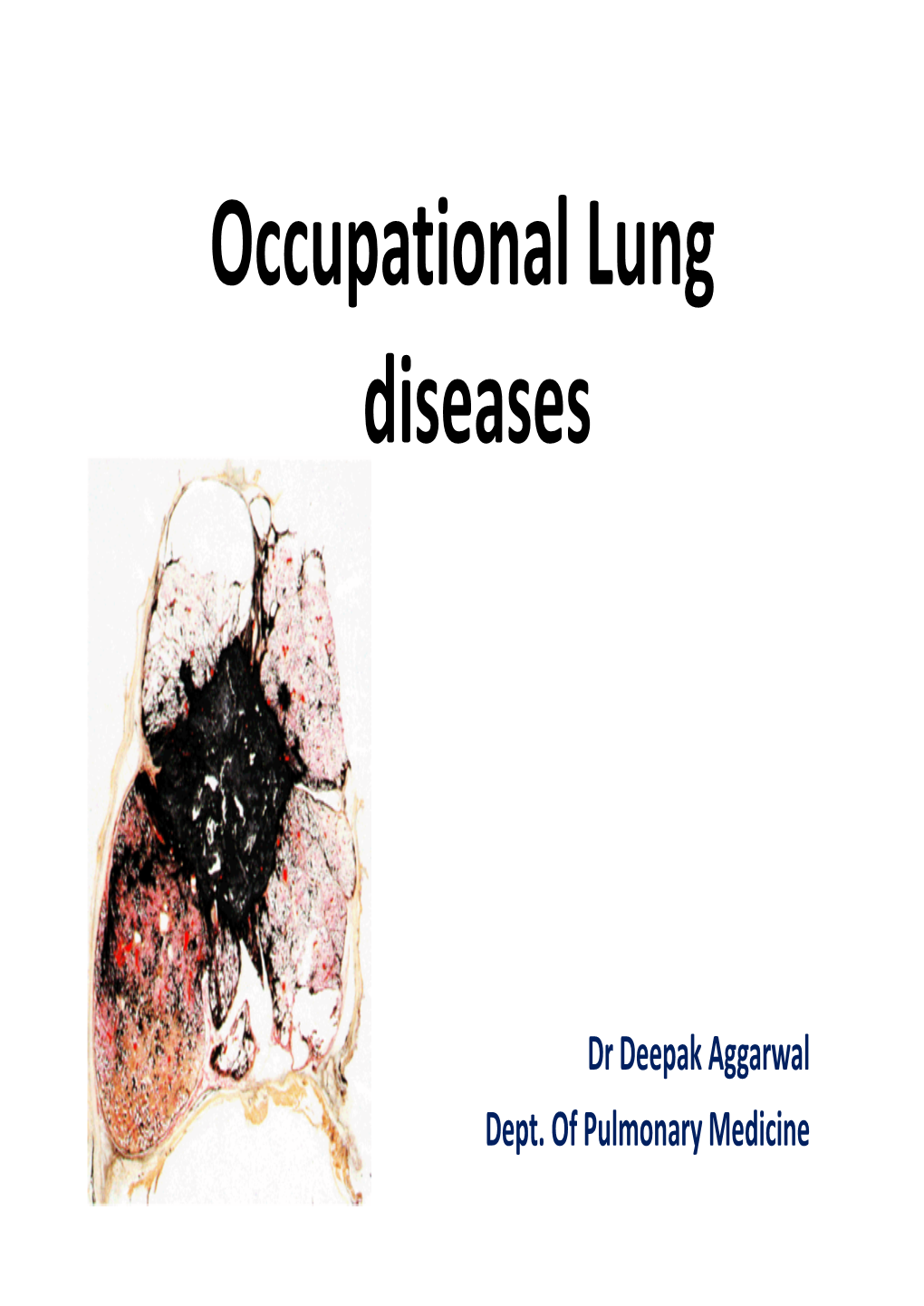 Occupational Lung Diseases