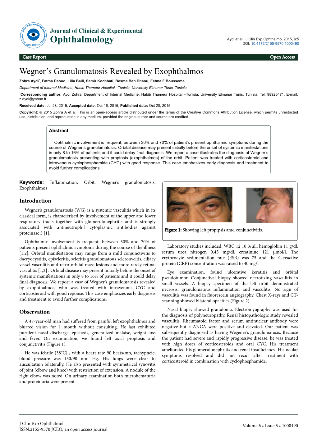 Wegner's Granulomatosis Revealed by Exophthalmos