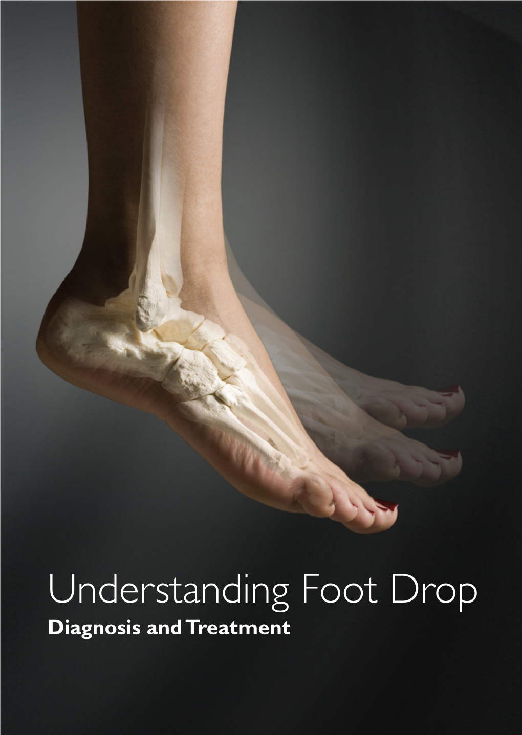 Understanding Foot Drop Diagnosis and Treatment WHAT IS FOOT DROP?