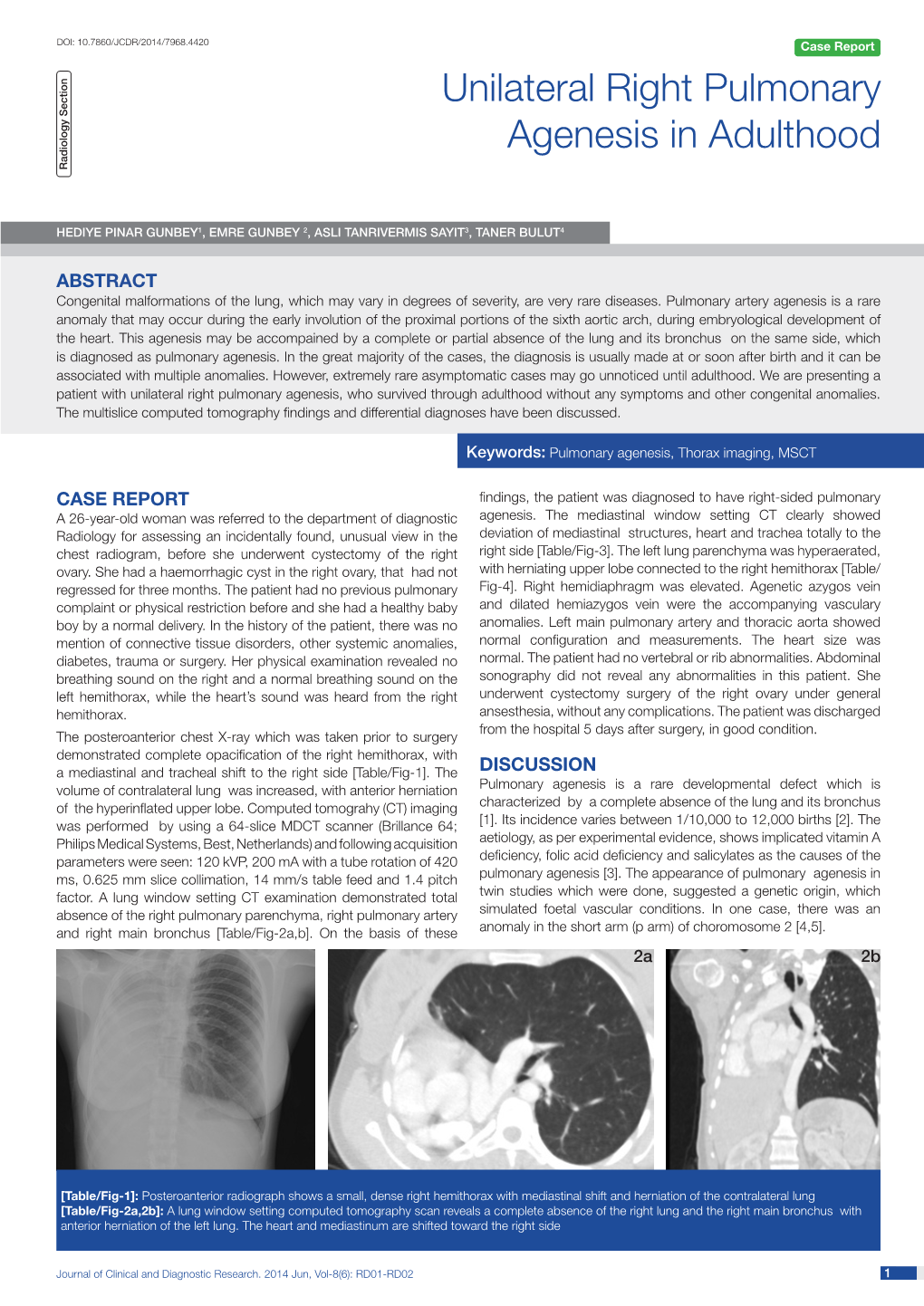 Unilateral Right Pulmonary Agenesis in Adulthood Radiology Section