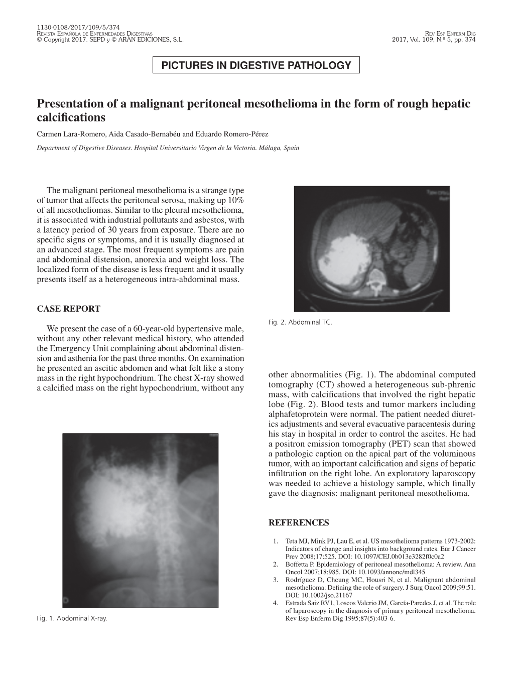 Presentation of a Malignant Peritoneal Mesothelioma in the Form of Rough