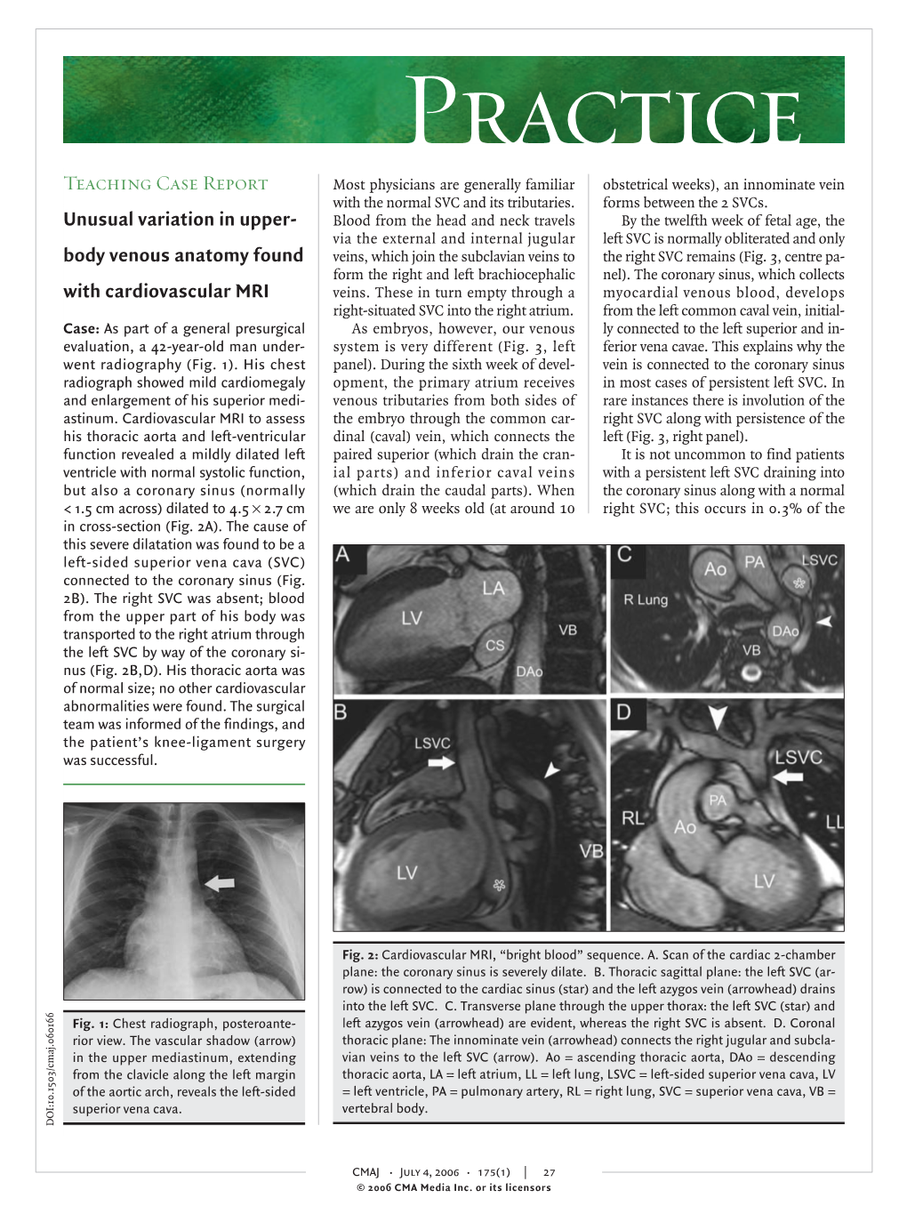 Body Venous Anatomy Found with Cardiovascular MRI