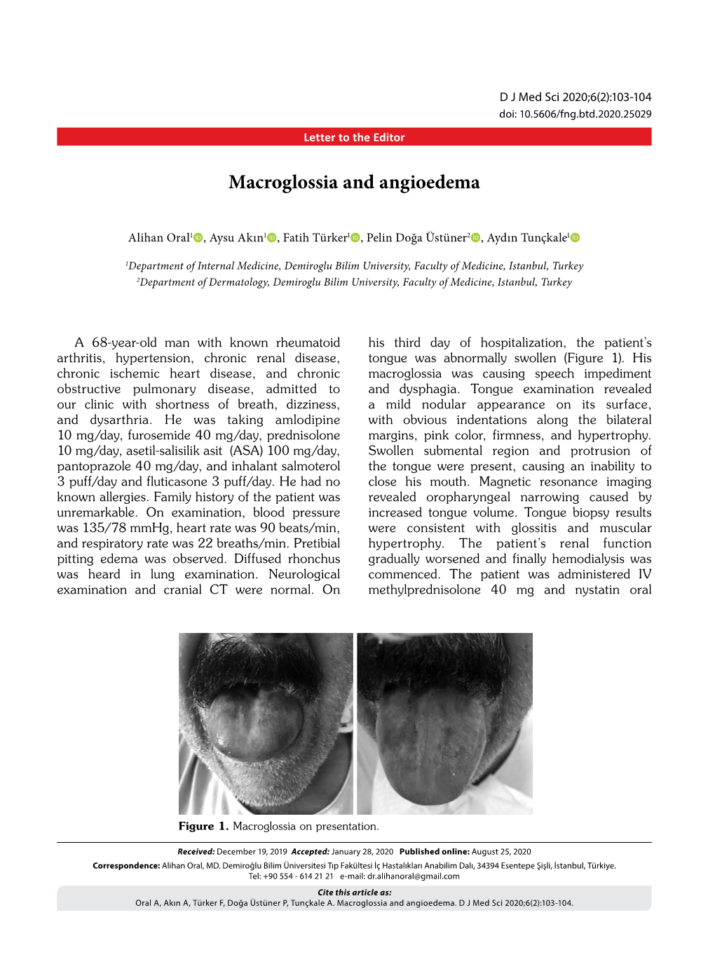 Macroglossia and Angioedema