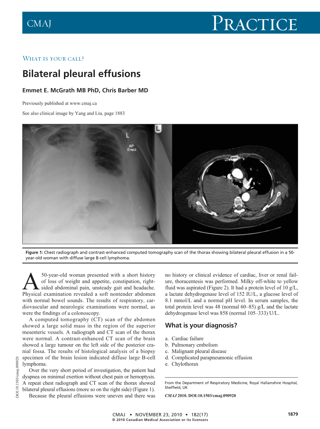 Bilateral Pleural Effusions