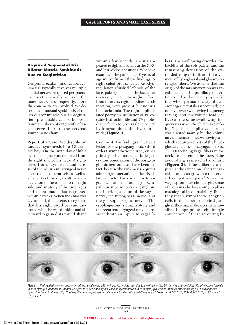 Acquired Segmental Iris Dilator Muscle Synkinesis