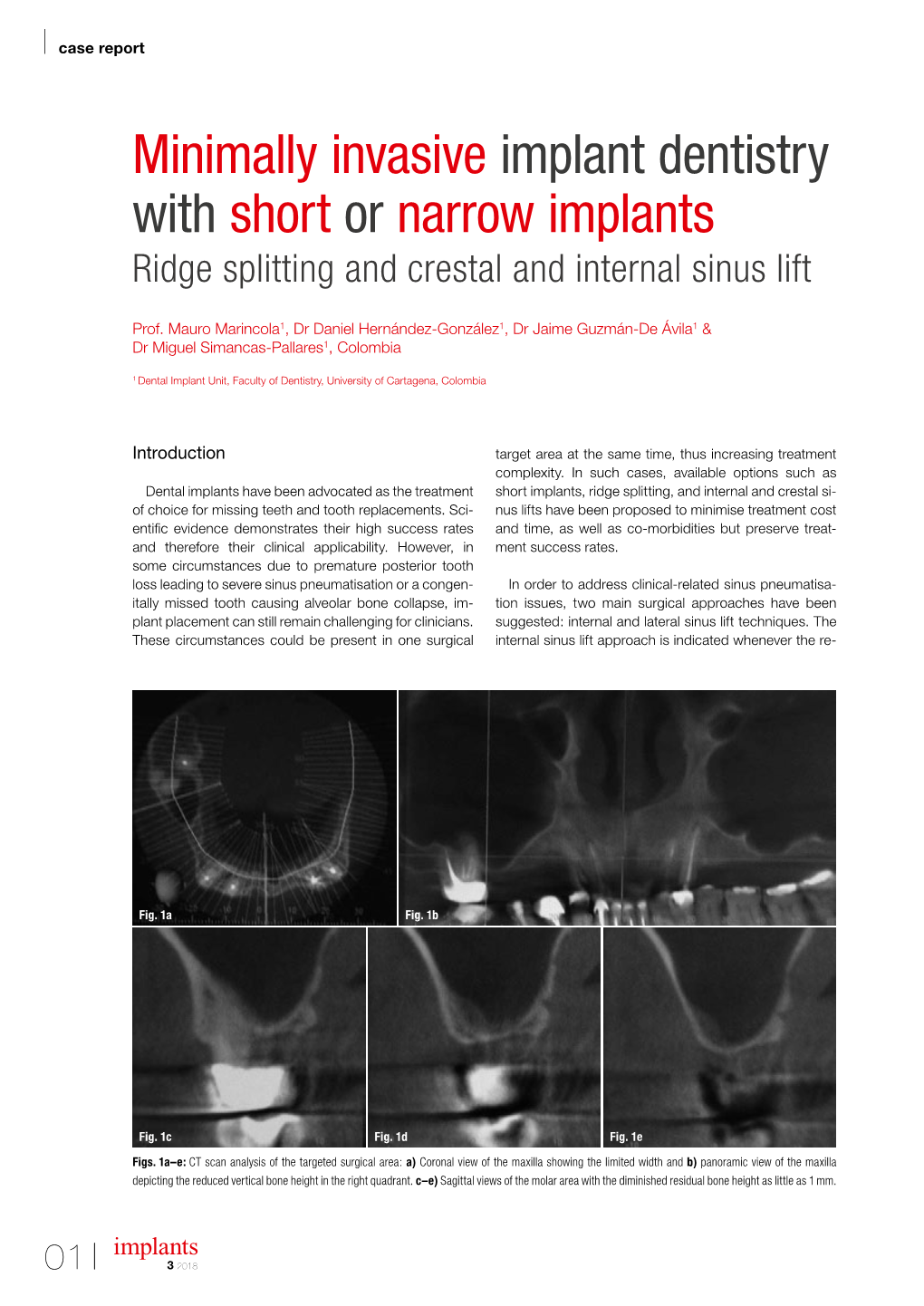 Minimally Invasive Implant Dentistry with Short Or Narrow Implants