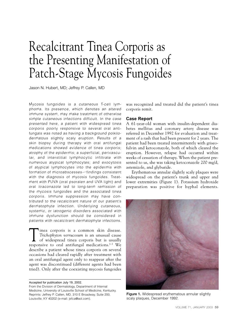 Recalcitrant Tinea Corporis As the Presenting Manifestation of Patch-Stage Mycosis Fungoides