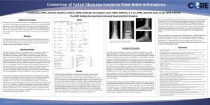 Conversion of Failed Tibiotalar Fusion to Total Ankle Arthroplasty This Powerpoint 2007 Template Produces a 36”X72” Presentation Poster