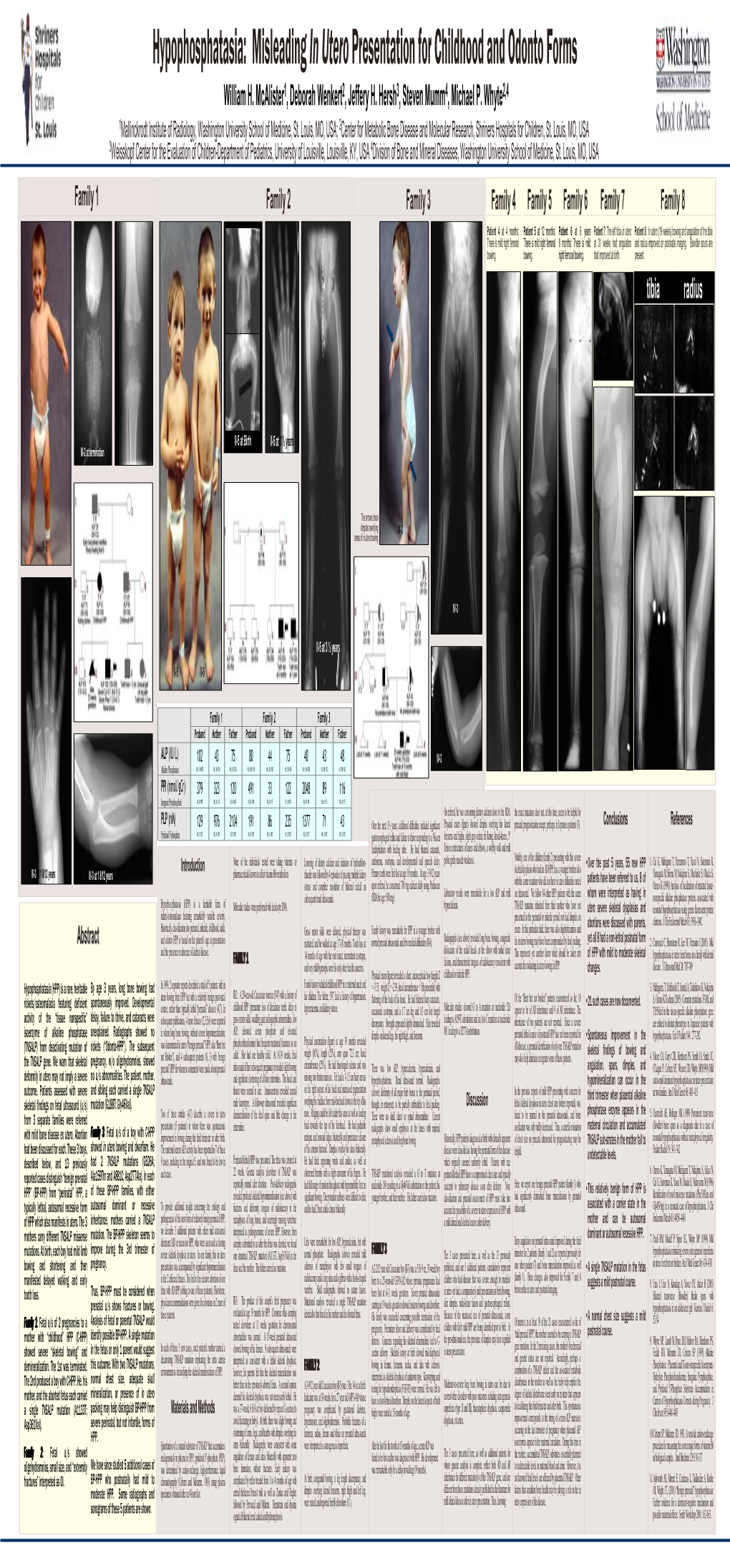 Hypophosphatasia: Misleading in Utero Presentation for Childhood and Odonto Forms William H