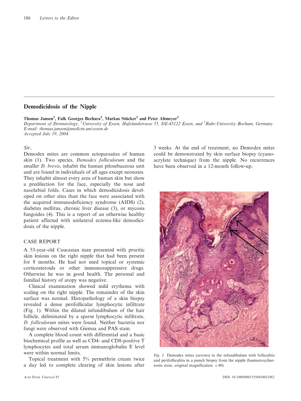 Demodicidosis of the Nipple