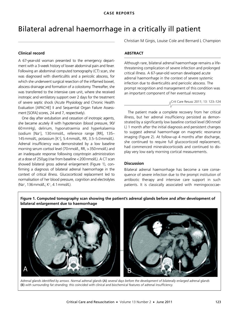 Bilateral Adrenal Haemorrhage in a Critically Ill Patient