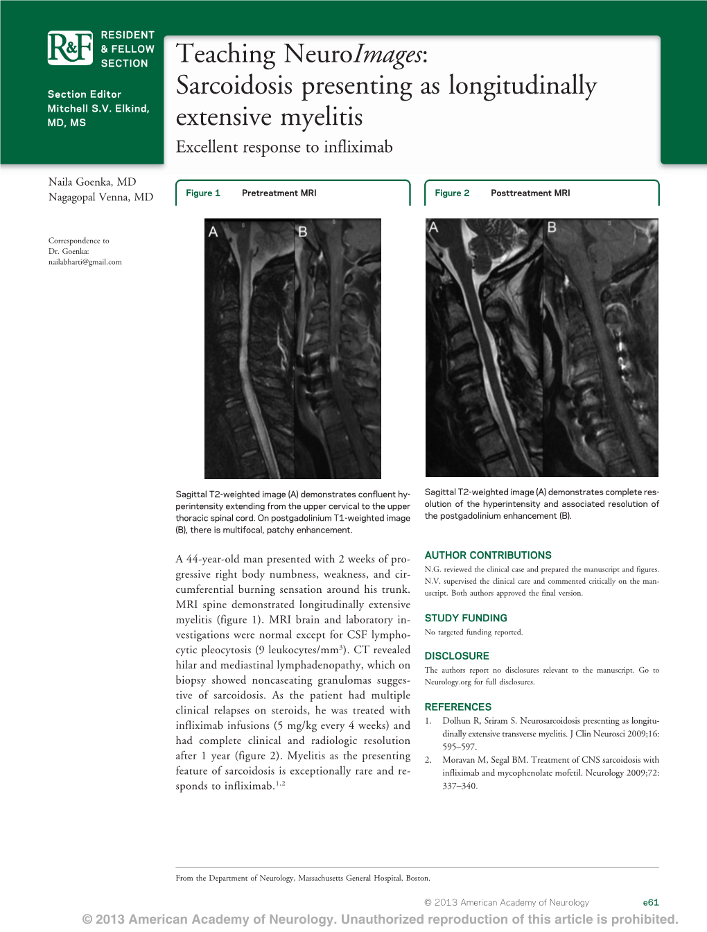 Sarcoidosis Presenting As Longitudinally Extensive