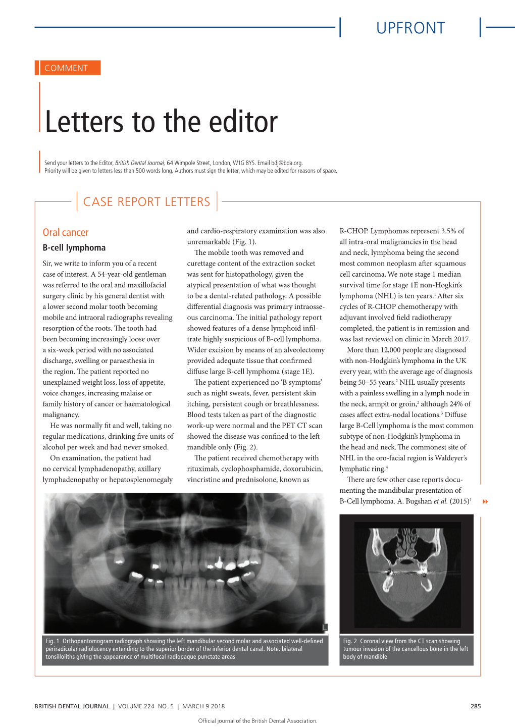 B-Cell Lymphoma