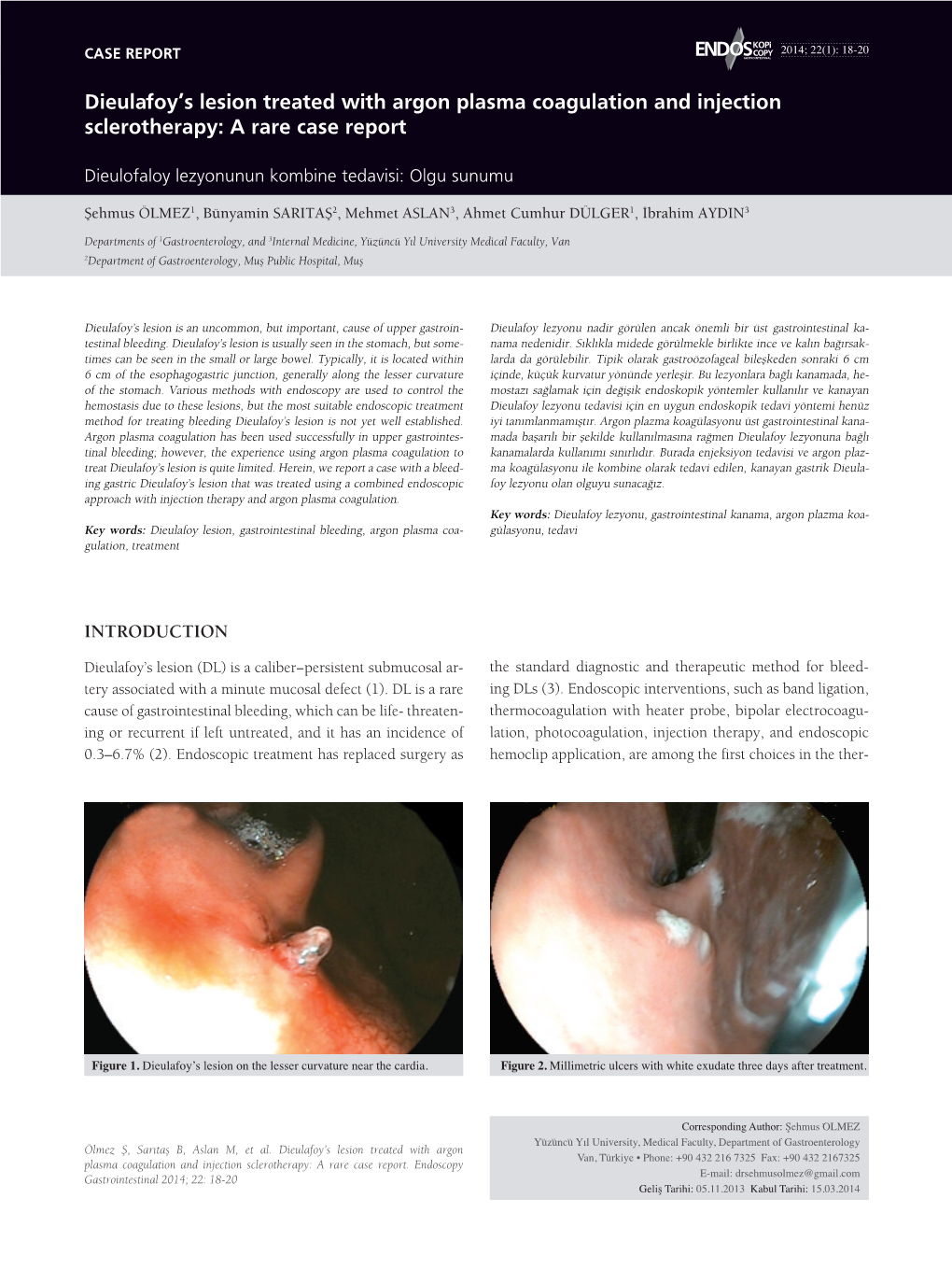 Dieulafoy's Lesion Treated with Argon Plasma Coagulation