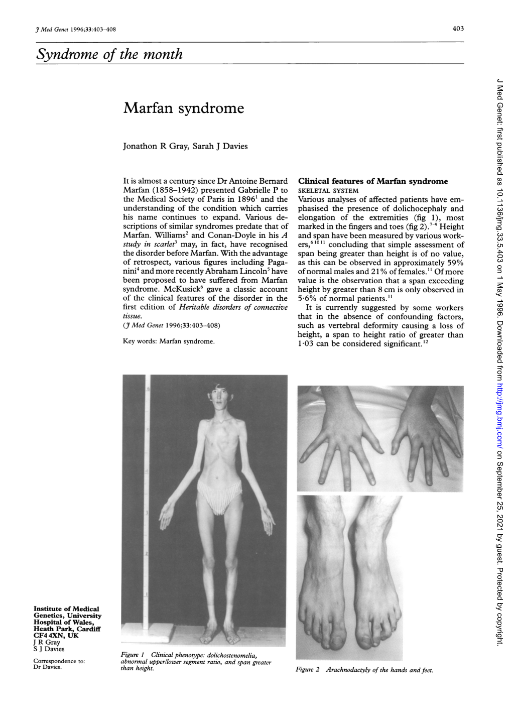 Syndrome of the Month J Med Genet: First Published As 10.1136/Jmg.33.5.403 on 1 May 1996