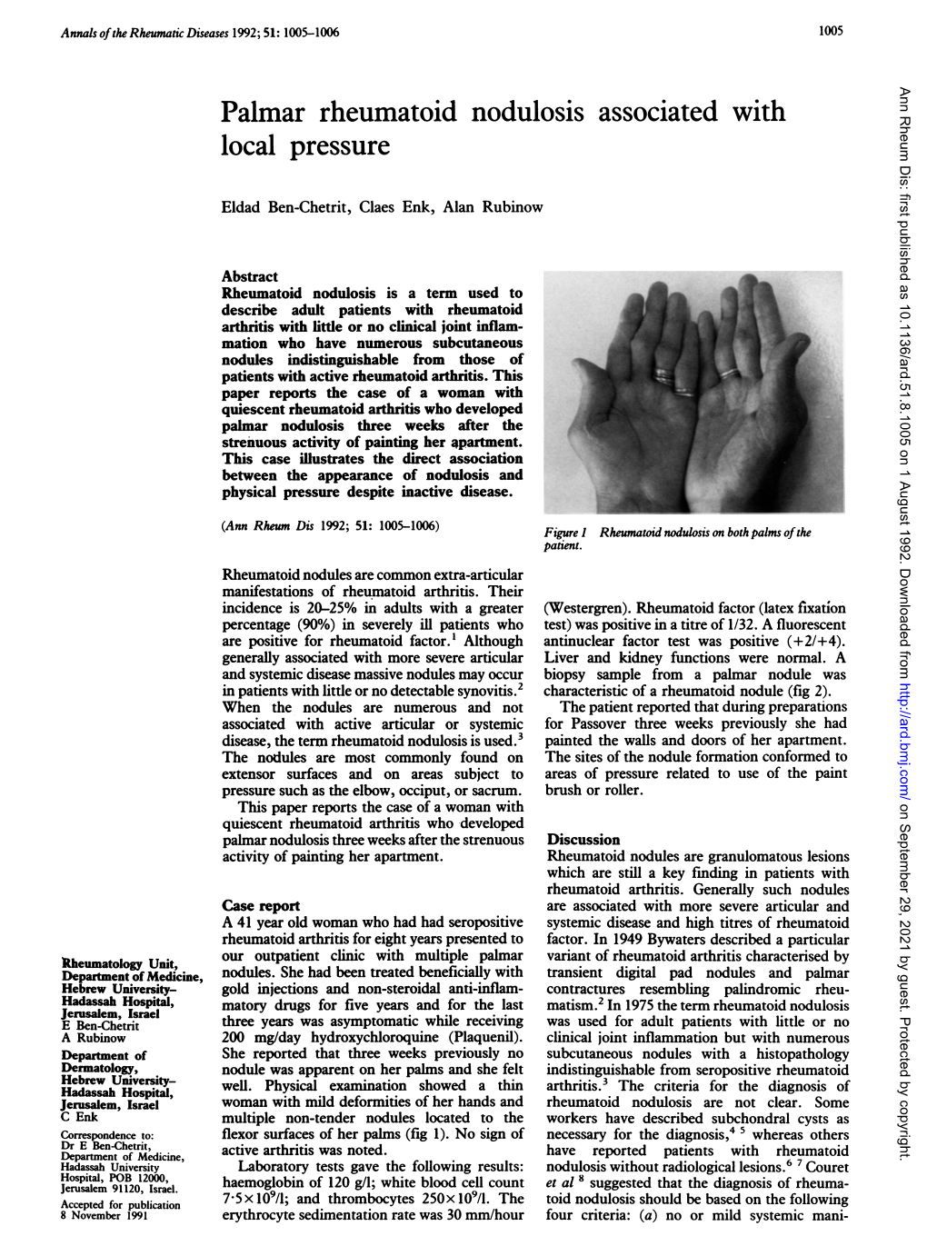 Palmar Rheumatoidnodulosis Associated With