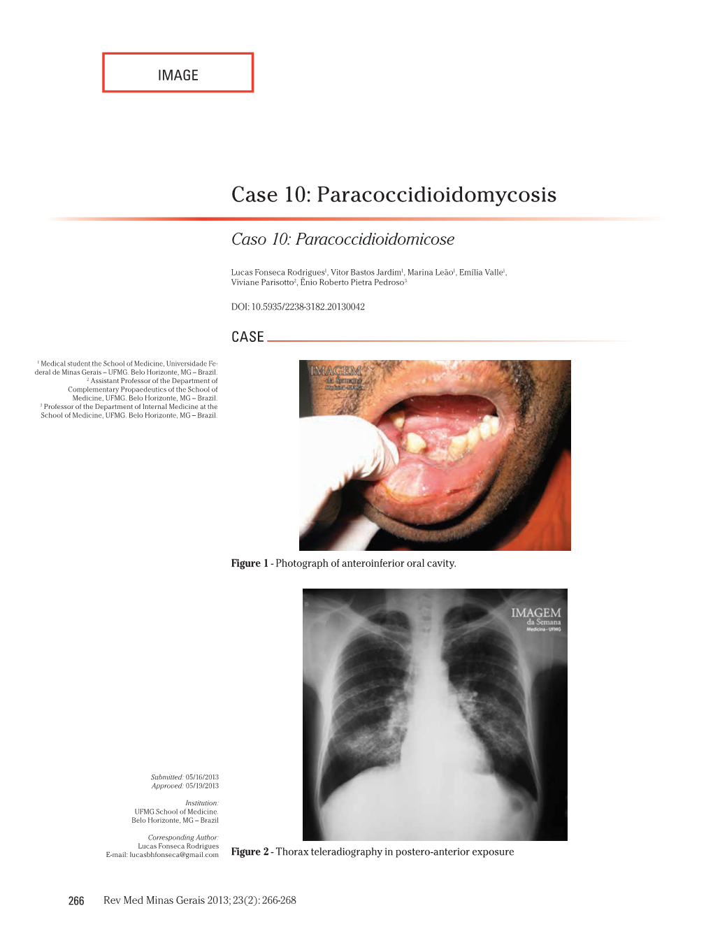 Paracoccidioidomycosis