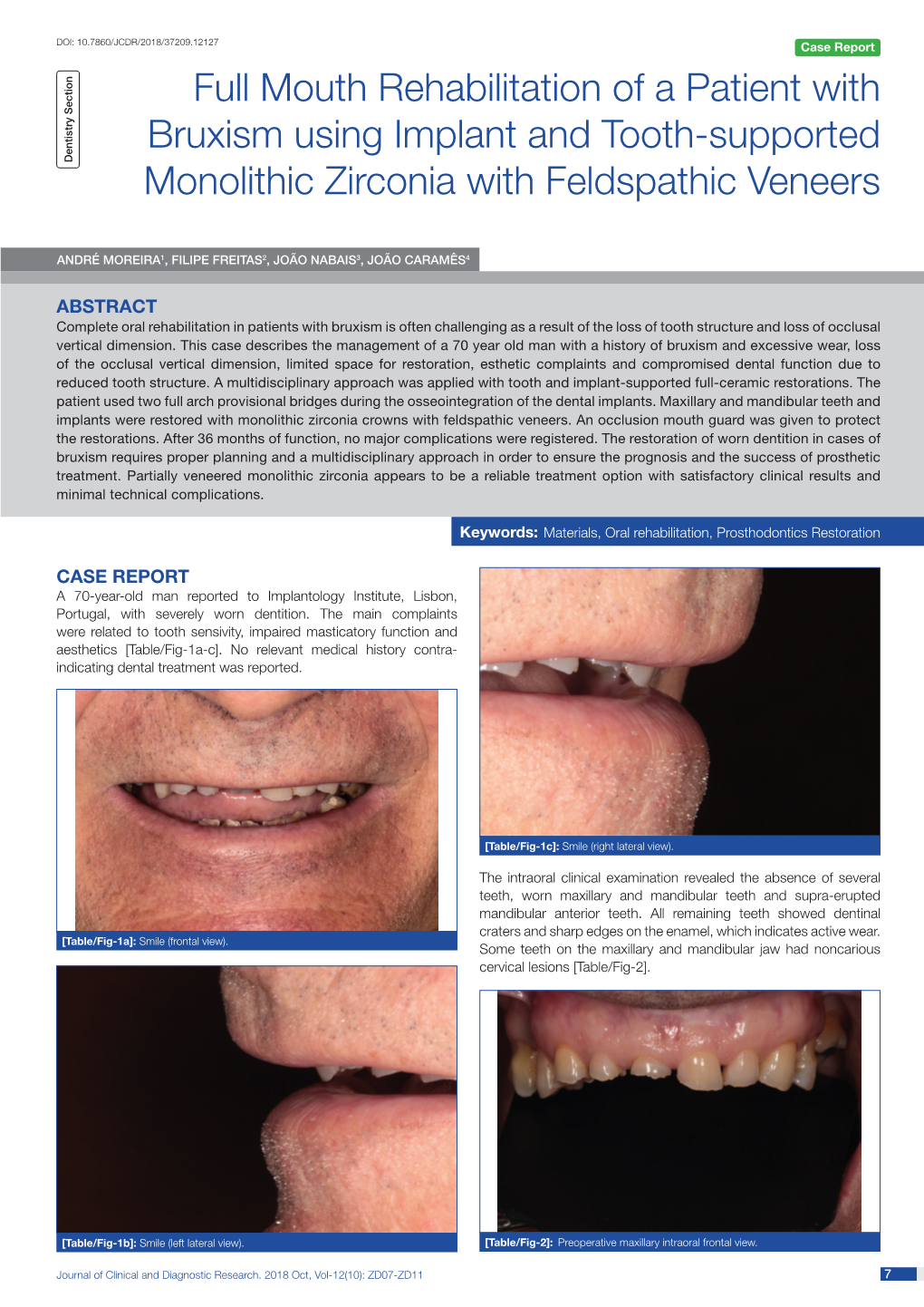 Full Mouth Rehabilitation of a Patient with Bruxism Using Implant and Tooth-Supported Dentistry Section Monolithic Zirconia with Feldspathic Veneers