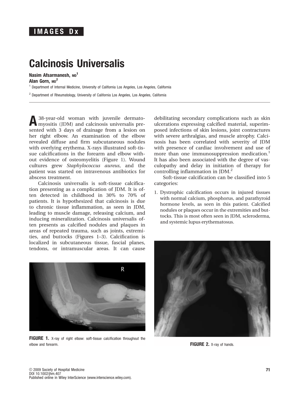 Calcinosis Universalis