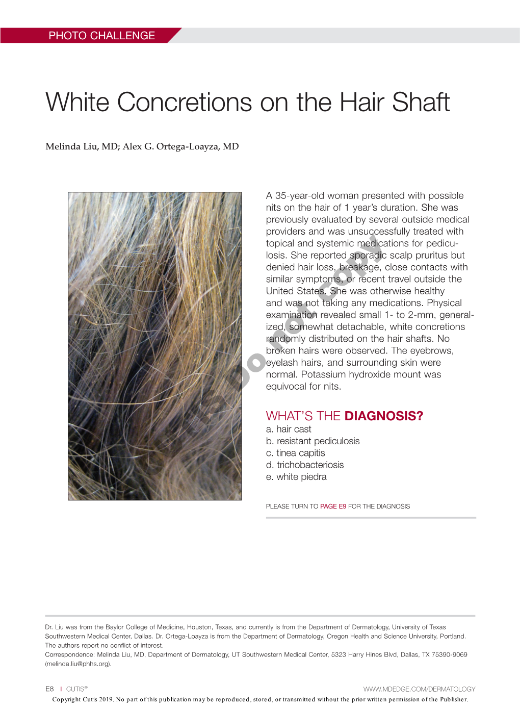 White Concretions on the Hair Shaft